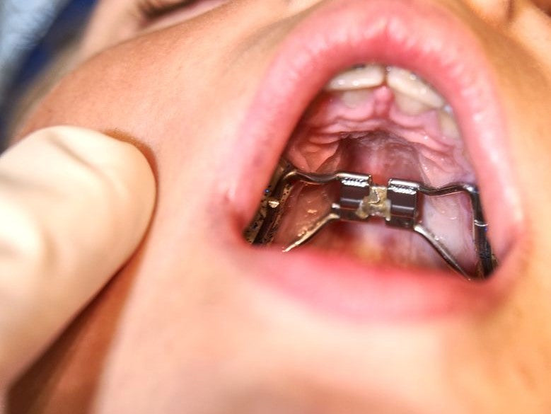 Close-up of a palatal expander inside a mouth
